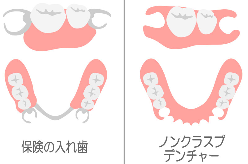 ノンクラスプデンチャー